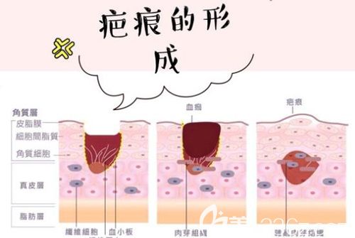 被称为医美绝缘体的疤痕性皮肤能不能做双眼皮呢