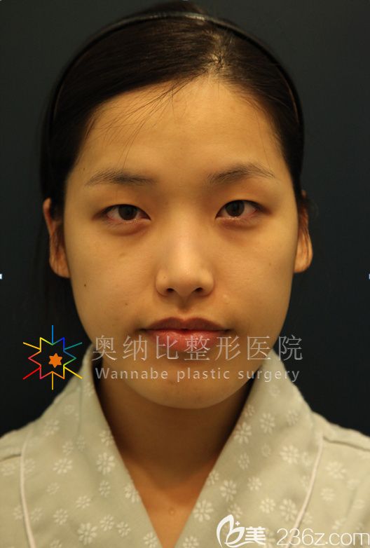 韩国奥纳比张哲豪做双眼皮怎么样 韩国奥纳比张哲豪做双眼皮怎么样