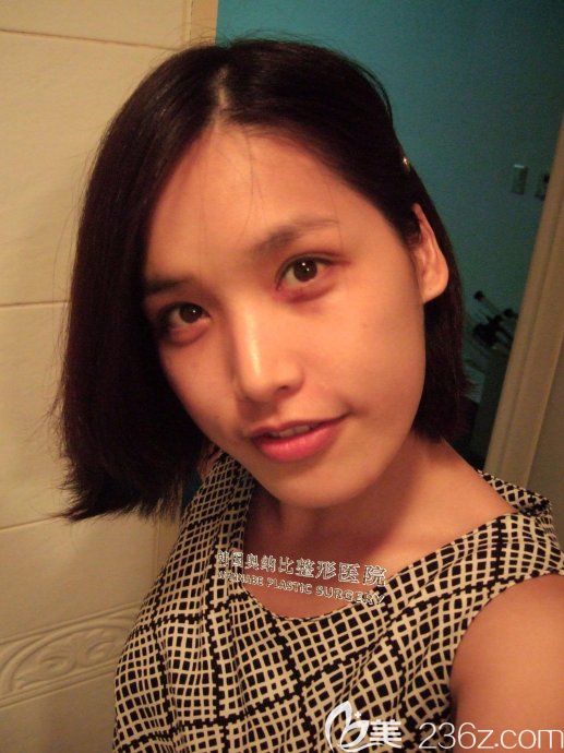 韩国奥纳比双眼皮真人案例 韩国奥纳比双眼皮真人案例