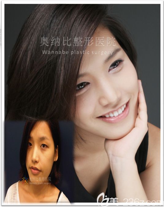 韩国奥纳比双眼皮真人案例 韩国奥纳比双眼皮真人案例