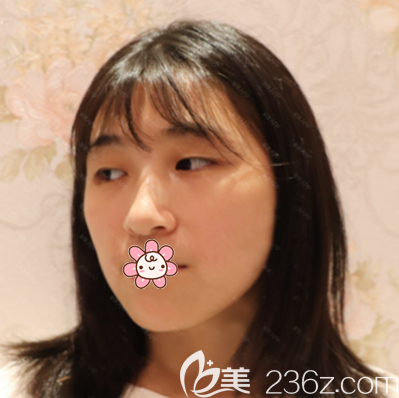 在佛山华美做双眼皮术前照片 在佛山华美做双眼皮术前照片