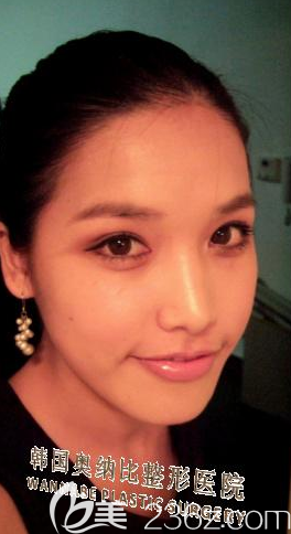 我已深深陷入韩国奥纳比张哲豪做的自然粘连法双眼皮+开内眼角的魅力中