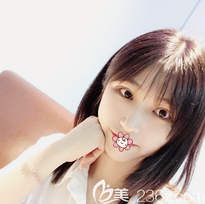 佛山华美梁宗建院长双眼皮案例 佛山华美梁宗建院长双眼皮案例