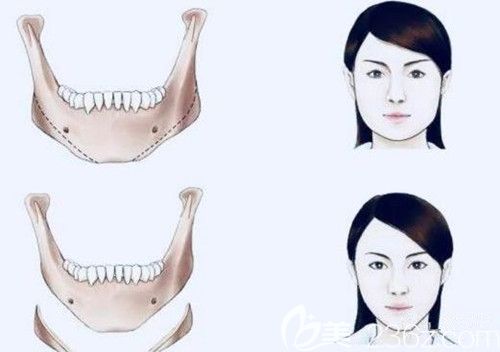 下颌角手术前后对比