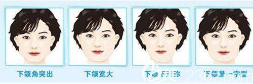 下颌角手术适合什么人群