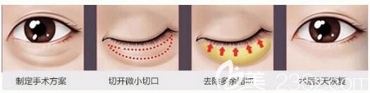 抽脂去假性眼袋原理