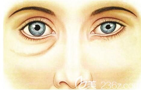 抽脂去假性眼袋效果对比