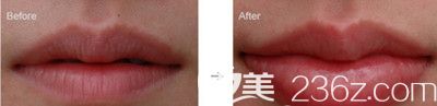 丰嘟嘟唇后术前术后对比