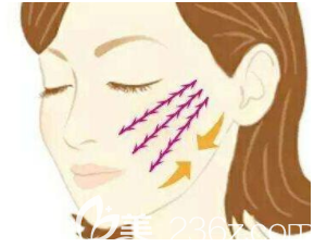 面部埋线提升示意图