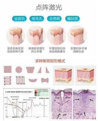 周口缔莱美CO2点阵激光祛疤