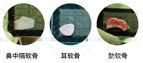 鼻综合中常用到的自体软骨材料分为：鼻中隔软骨、耳软骨、肋软骨