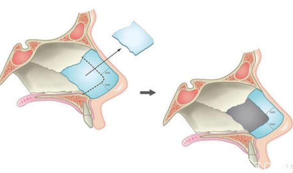 一定范围内取鼻中隔软骨后鼻子不会塌陷