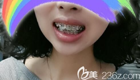 龅牙矫正第12天变化图