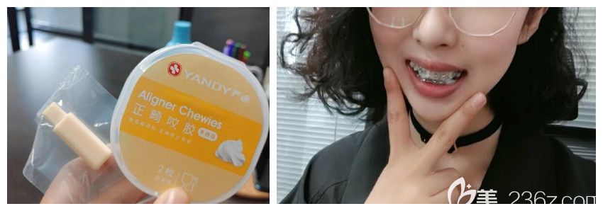 戴钢丝牙套矫正龅牙第5天