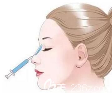 玻尿酸隆鼻会不会变形？鼻子会变宽吗？