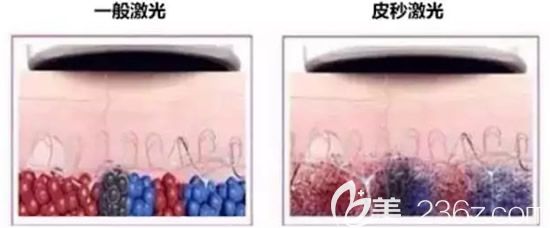 一般激光与皮秒激光的区别 一般激光与皮秒激光的区别