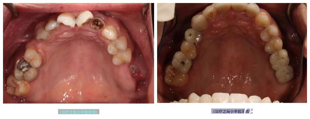 王晓勇为25岁的小李做即刻种植牙案例 王晓勇为25岁的小李做即刻种植牙案例