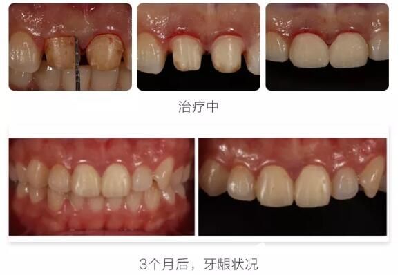徐路路门牙全瓷冠失败修复案例前后效果对比图 徐路路门牙全瓷冠失败修复案例前后效果对比图