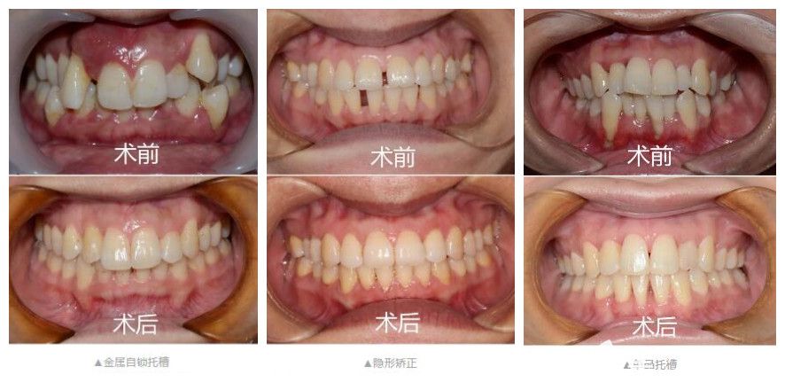 金属托槽矫正虎牙+隐形矫正牙缝稀疏+自锁托槽矫正拥挤不齐牙齿 金属托槽矫正虎牙+隐形矫正牙缝稀疏+自锁托槽矫正拥挤不齐牙齿