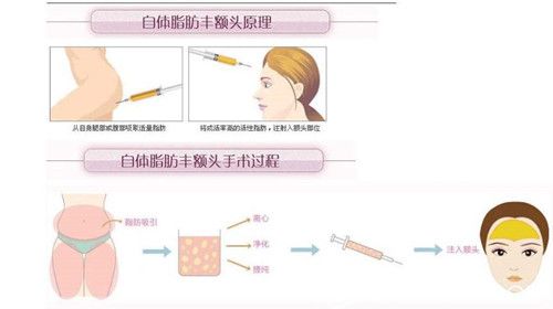 自体脂肪丰额头示意图