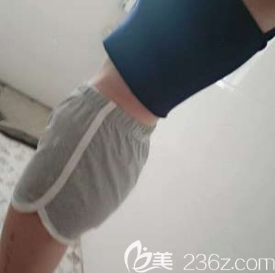 泉州脂管加邵起民医生为腰腹吸脂术后一个月照片 泉州脂管加邵起民医生为腰腹吸脂术后一个月照片