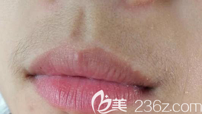 唇毛让女性充满男性化