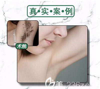 信阳东方艺冰点激光脱毛案例