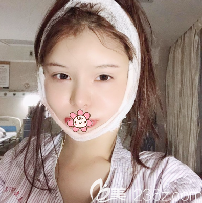 下颌角磨骨术后7天恢复效果图 下颌角磨骨术后7天恢复效果图