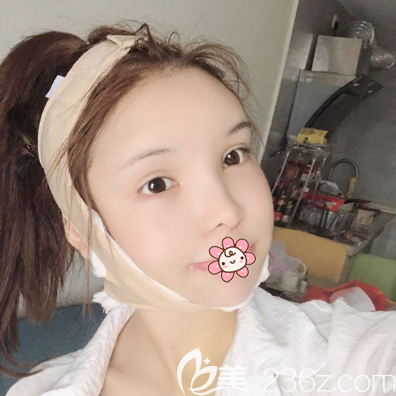 徐威强磨骨案例术后15天效果图 徐威强磨骨案例术后15天效果图