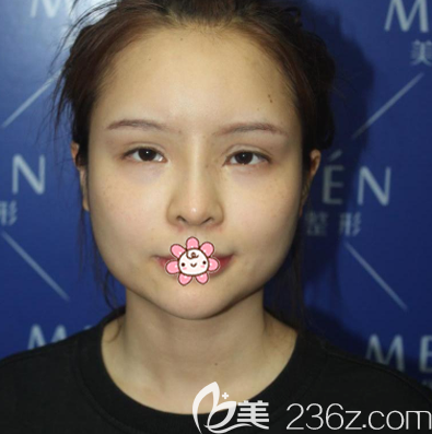 在广州美恩做下颌角术前照片 在广州美恩做下颌角术前照片