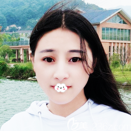 看到朋友找广州广大医院做的磨骨案例效果那么好我也去做了削下颌角手术