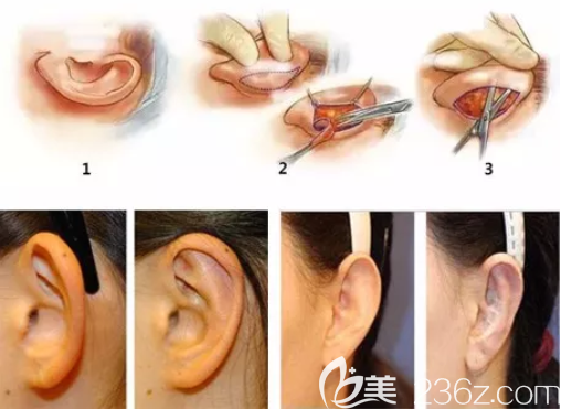 招风耳治疗图解和效果