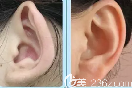 招风耳矫正后效果对比