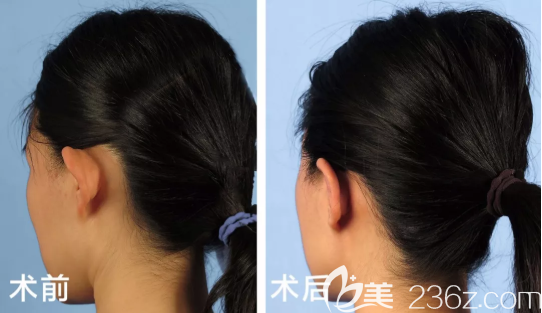 招风耳矫正案例