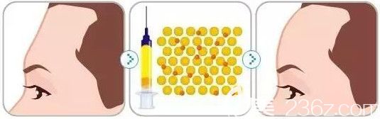 自体脂肪填充额头手术效果
