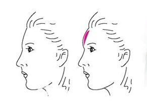 额头饱满和不饱满的对比