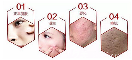 痘坑痘印是如何产生的