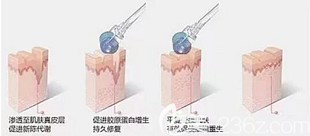 微针去除痘坑痘印的原理