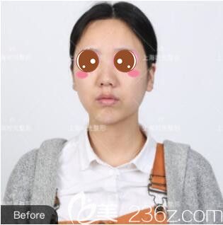 <!--<i data=20240703-sp></i>-->时光何晋龙鼻综合真人案例术前照 <!--<i data=20240703-sp></i>-->时光何晋龙鼻综合真人案例术前照