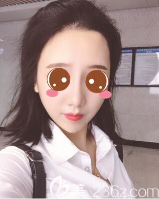 <!--<i data=20240703-sp></i>-->时光何晋龙鼻综合真人案例术后21天 <!--<i data=20240703-sp></i>-->时光何晋龙鼻综合真人案例术后21天