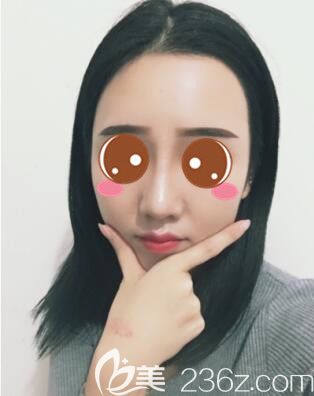 <!--<i data=20240703-sp></i>-->时光何晋龙鼻综合真人案例术后47天 <!--<i data=20240703-sp></i>-->时光何晋龙鼻综合真人案例术后47天