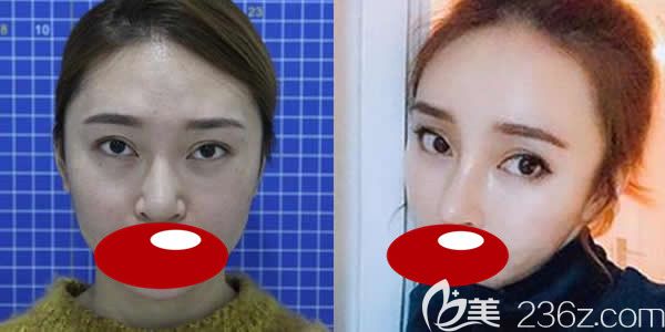 泉州东大徐海燕医生硅胶+耳软骨综合隆鼻真人案例效果