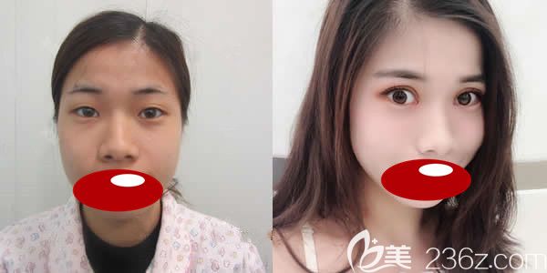 泉州东大吴新建医生做切开双眼皮+开内眼角真人案例前后对比图