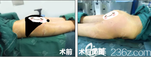 王军主任做完手术当时