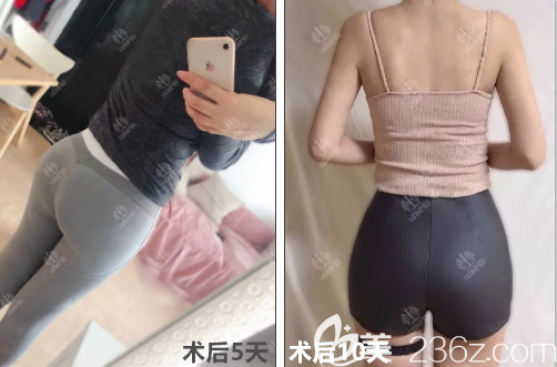 王军自体脂肪丰臀术后10天