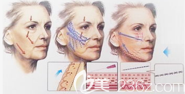 埋线提升手术过程图