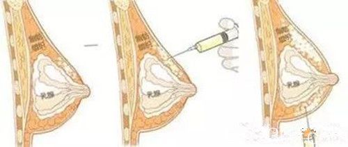自体脂肪分层次注射提高成活率