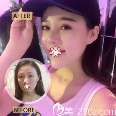 重庆艺星整形朱家旭垫下巴效果 重庆艺星整形朱家旭垫下巴效果