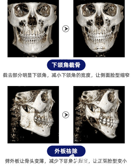 下颌角截骨和去外板的术后效果图对比