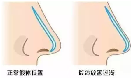 假体置入过浅示意图